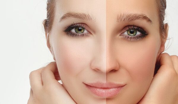 cilt tonu esitsizligi