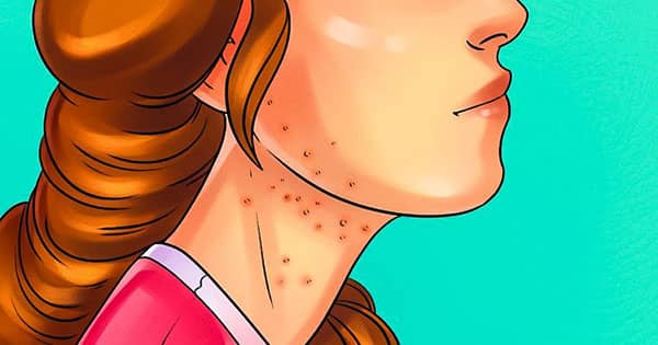 ciltte bozukluk belirtileri